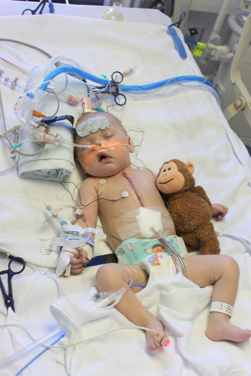 Bidirectional Glenn Physiology