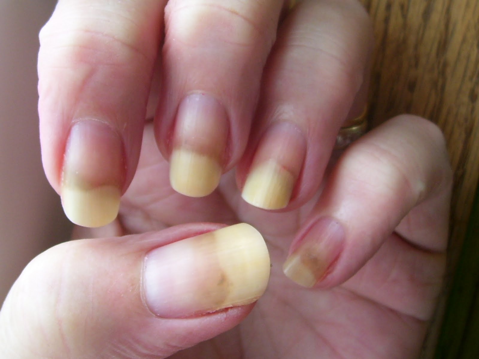 NAILED IT!: Nail Trauma.