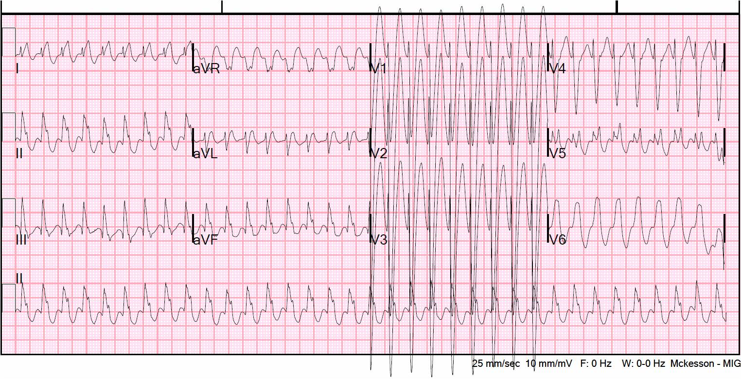 av reentrant tachycardia