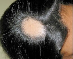 Vichy dercos el cabello, que refuerza contra la caída
