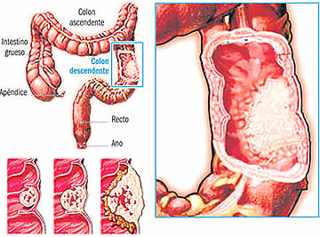 cancer de colon.