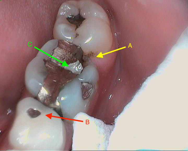 dental calculus broke off dental calculus broke off