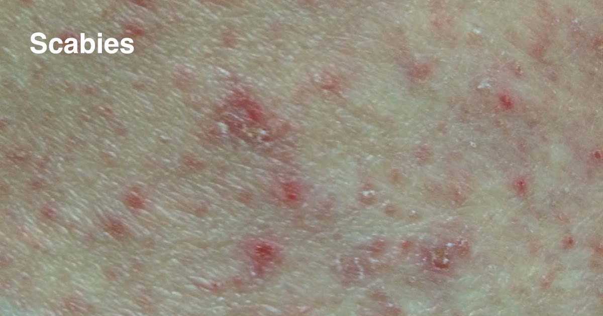 David Robles, MD, PhD Dermatologist Scabies is a contagious disease