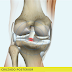 Protocolo de reabilitação para as reconstruções isoladas do ligamento cruzado posterior