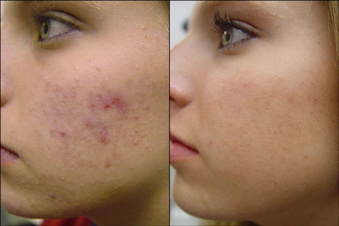 Acne Herpes