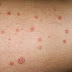 Psoriasis Types & Causes & Cure