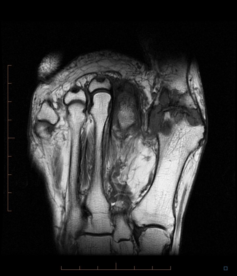 Radiology Cases Gout