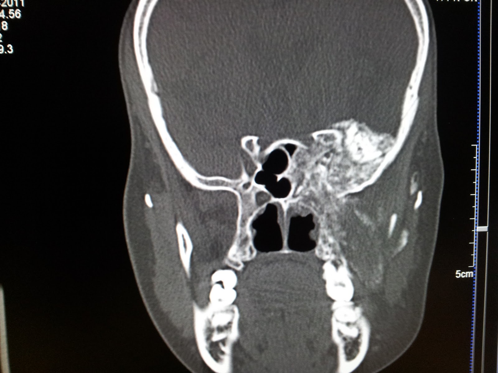 characteristics of fibrous dysplasia a rare bone disease characteristics of fibrous dysplasia a rare bone disease