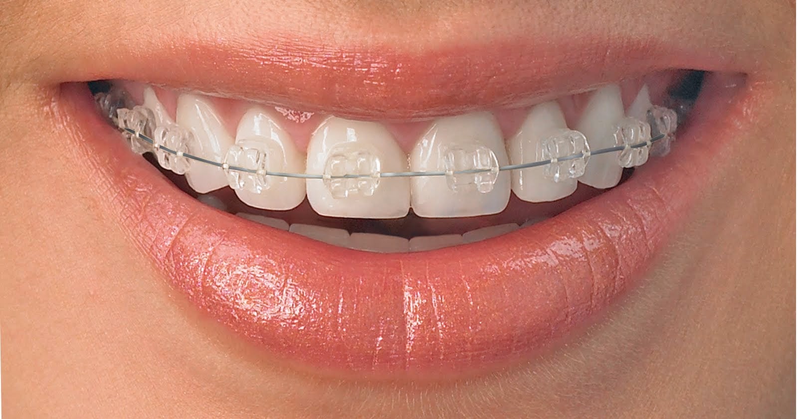 clear ceramic braces