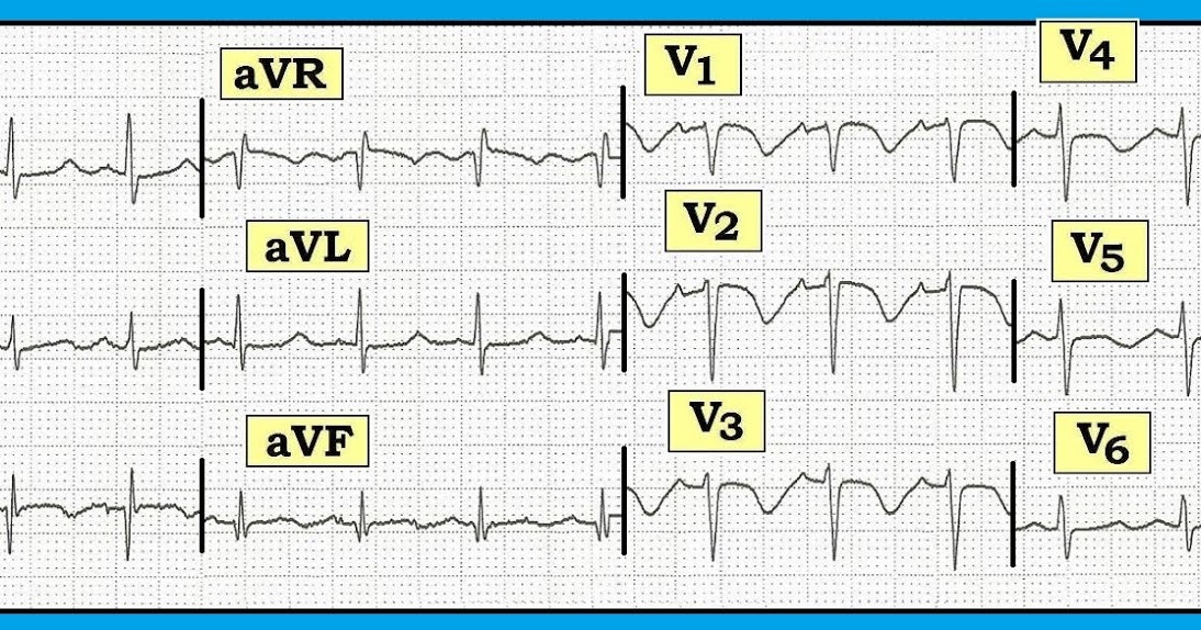 ECG Interpretation ECG Blog 119 (Anterior T Wave Inversion Ischemia