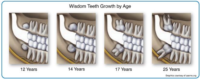 age wisdom teeth emerge