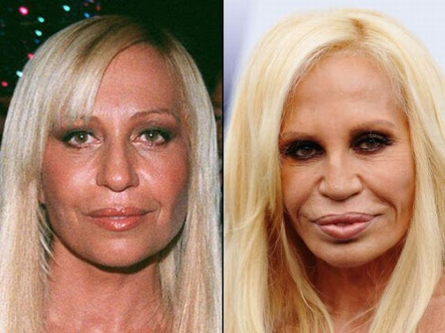 Donatella Versace Antes y Despues Donatella Versace Antes y Despues