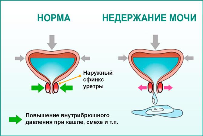 Уролог: недержание мочи у женщин – опасная патология. Однако сегодня она просто лечится в домашних