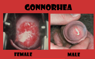 Obat alami untuk penyakit gonore atau kencing keluar nanah