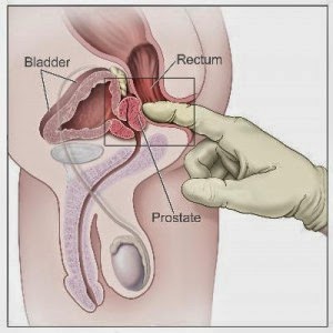 pengobatan alternatif tumor Prostat, obat kanker prostat, pengobatan kanker prostat
