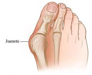 El Corrector Nocturno Hallux-Valgus consigue una alineación progresiva de las partes blandas y articulaciones.