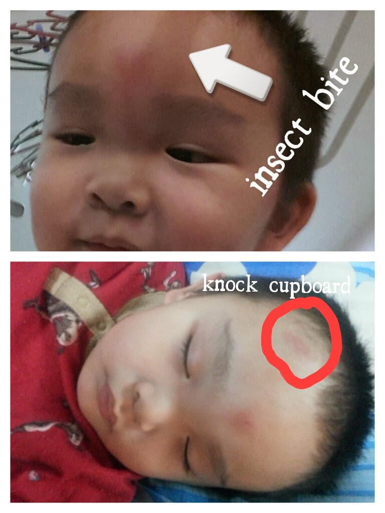 My Mom's Best Insect bite on forehead swelling