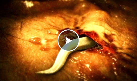 tapeworms in tapeworms in human bodies tapeworms in tapeworms in human bodies