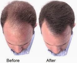 Hairstrongways علاج تساقط الشعر للرجال