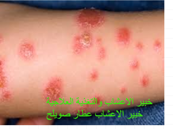  لطلب اي منتج علاجي الاتصال بخبير الاعشاب والتغذية العلاجية http://rdeh76.blogspot.com/ خبير الاعشاب عطار صويلح 00962779839388