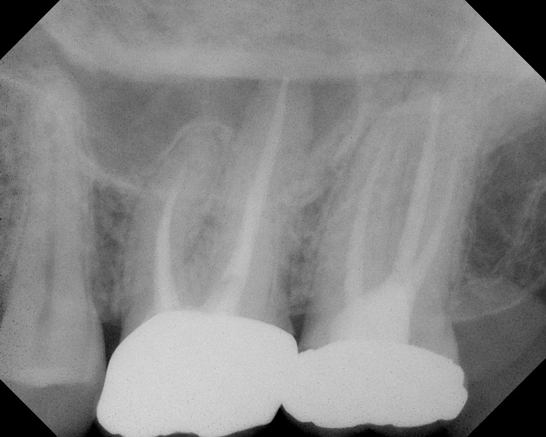 The Endo Blog Cone Beam CT in Endodontic Diagnosis