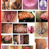 Obat Kutil Kelamin Tradisional AMPUH thumbnail