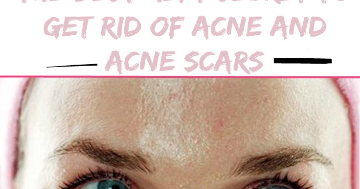 How To Get Rid Of Really Bad Acne Naturally How To Get Rid Of Really Bad Acne Naturally