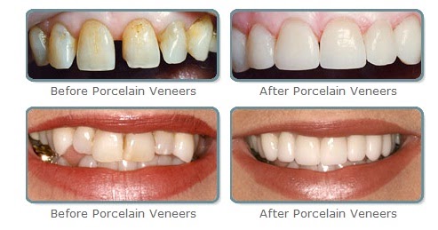 teeth veneers pros and cons