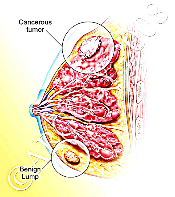 diagrams of breast cancer mambulaoans worldwide buzz breast cancer and diagrams of breast cancer mambulaoans worldwide buzz breast cancer and