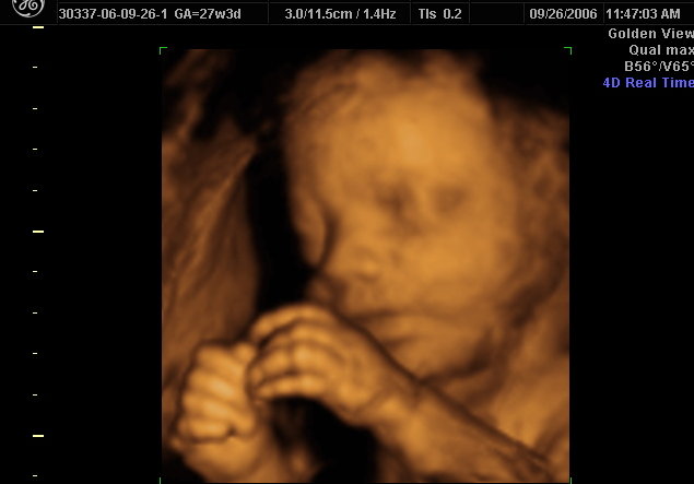 3d Scanner Image 3d Sonogram