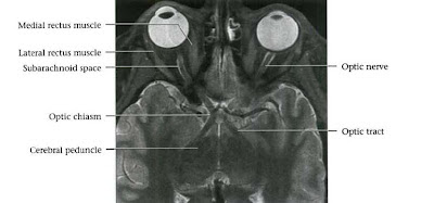 Dr Balaji Anvekar FRCR: Cranial Nerves Normal MRI Anatomy