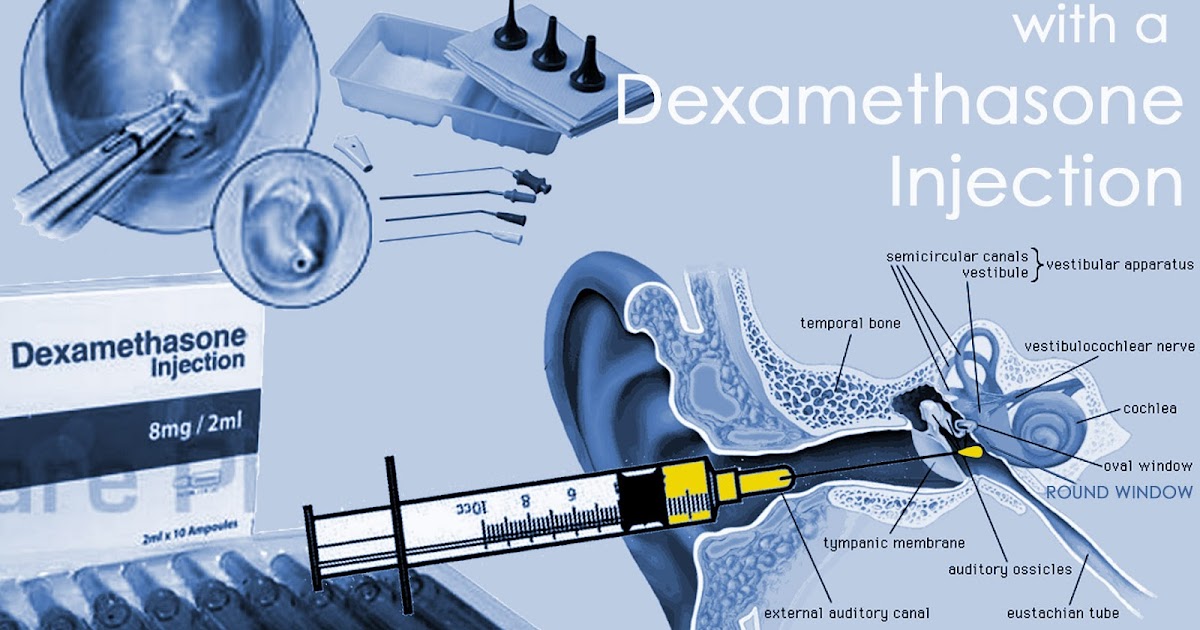 Menieres An Inner (Ear) Journey MORE on Intratympanic Dexamethasone