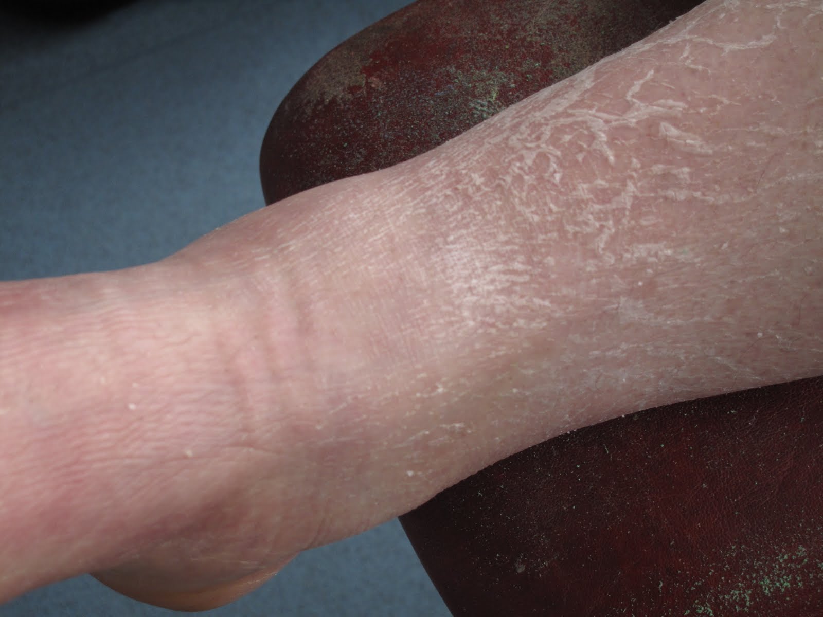 Danielle Roberts The plaster cast comes off!