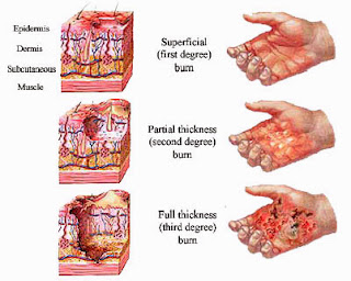 Macam-Macam Luka Bakar