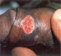 Gambar sipilis pada pria Gambar sipilis pada pria