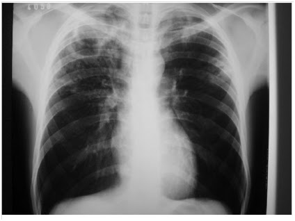 Artigos tuberculose