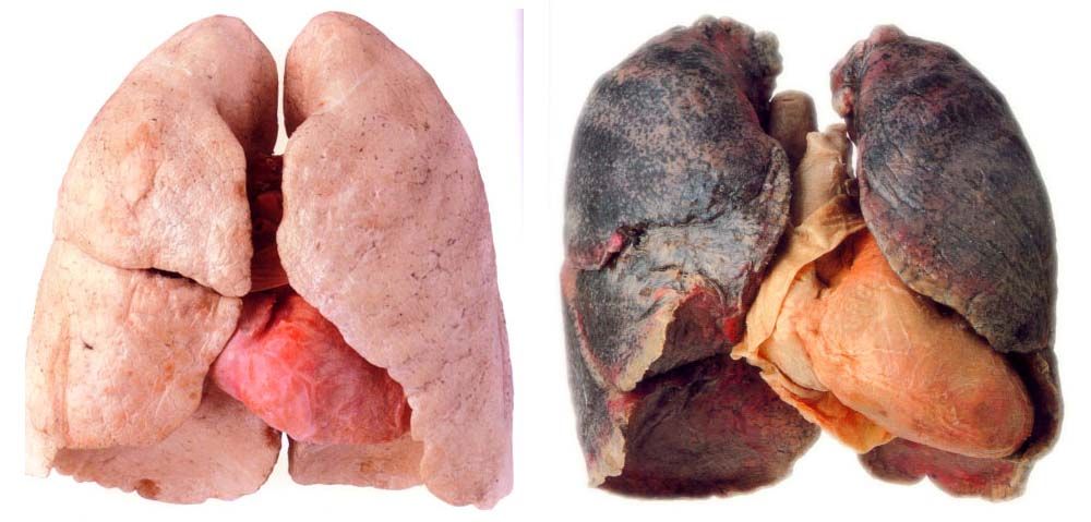 Healthy Lung Pictures