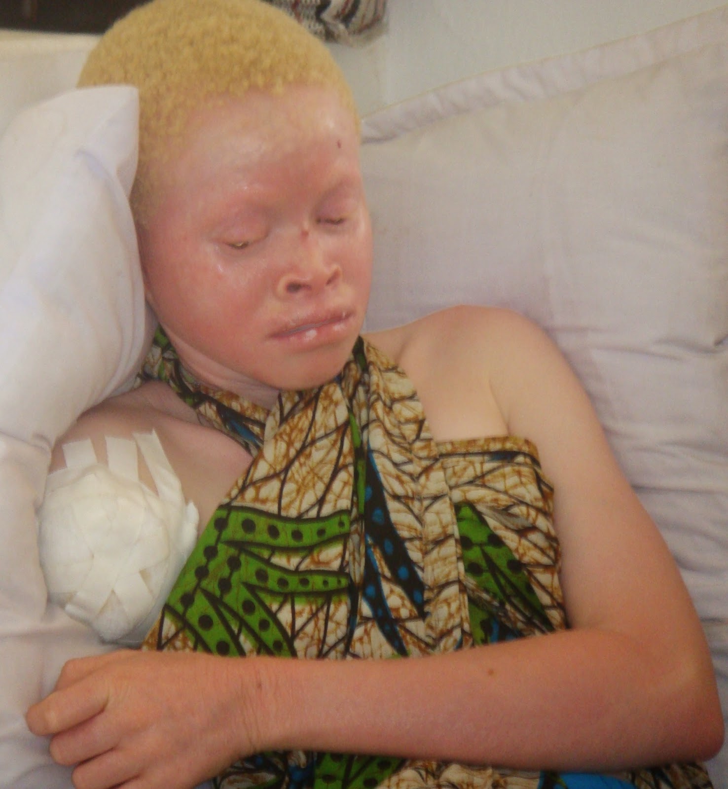 Nake african albino girl pics - Porn archive