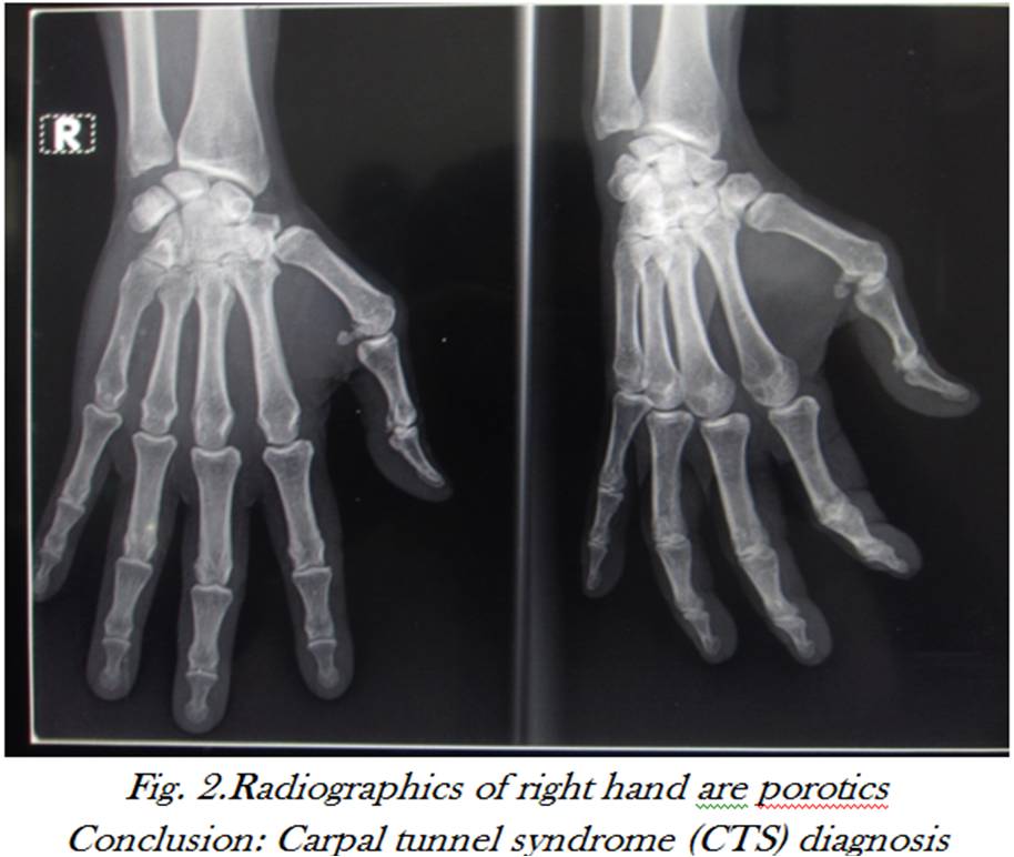 Orthopaedi Knowledges ABILITY TO UNDERSTAND THE CARPAL TUNNEL SYNDROME