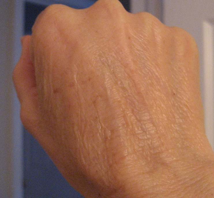 Chemical Peels for Acne and Anti Aging Hands Really Tell Our Age