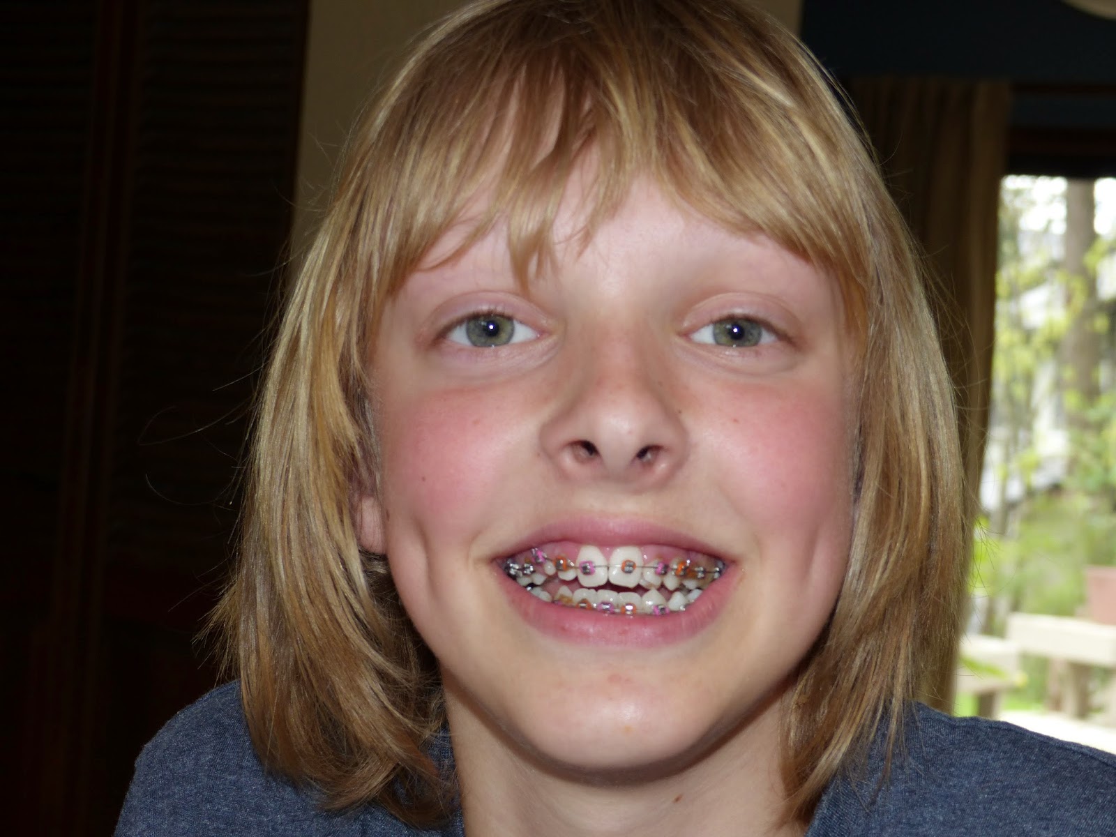 Deep Cover Day Braces!