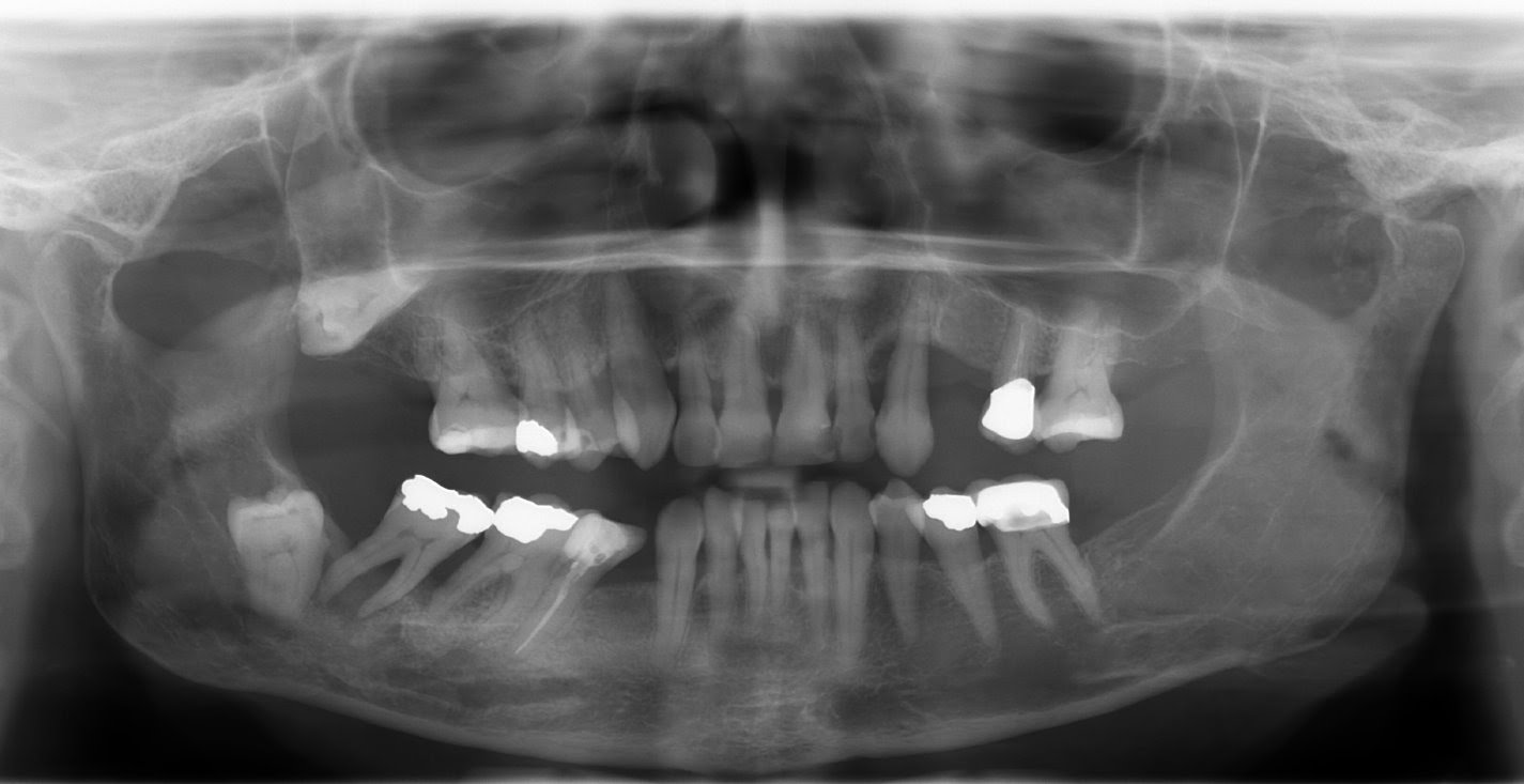 Dental sky All about healthy smile Contraindications for removal of