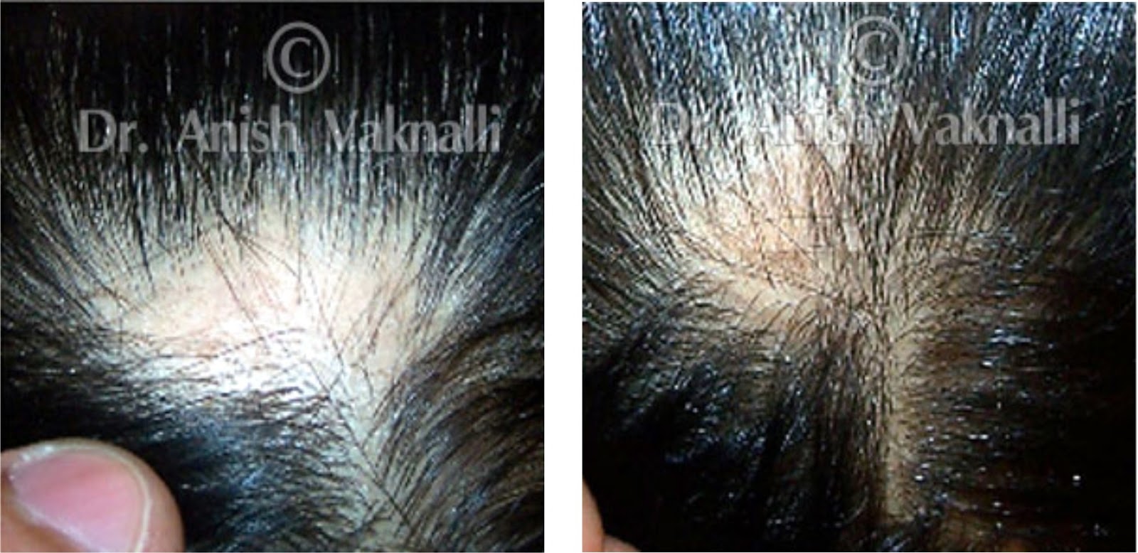 HomeoConsult RD Hair Loss homeopathy doctor treatment, medicines