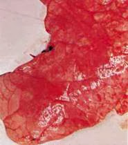 Hình 2: Viêm phổi thùy lớn