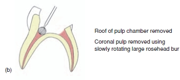 Pulpotomy : Indications and Procedure of pulpotomy image59 Pulpotomy : Indications and Procedure of pulpotomy