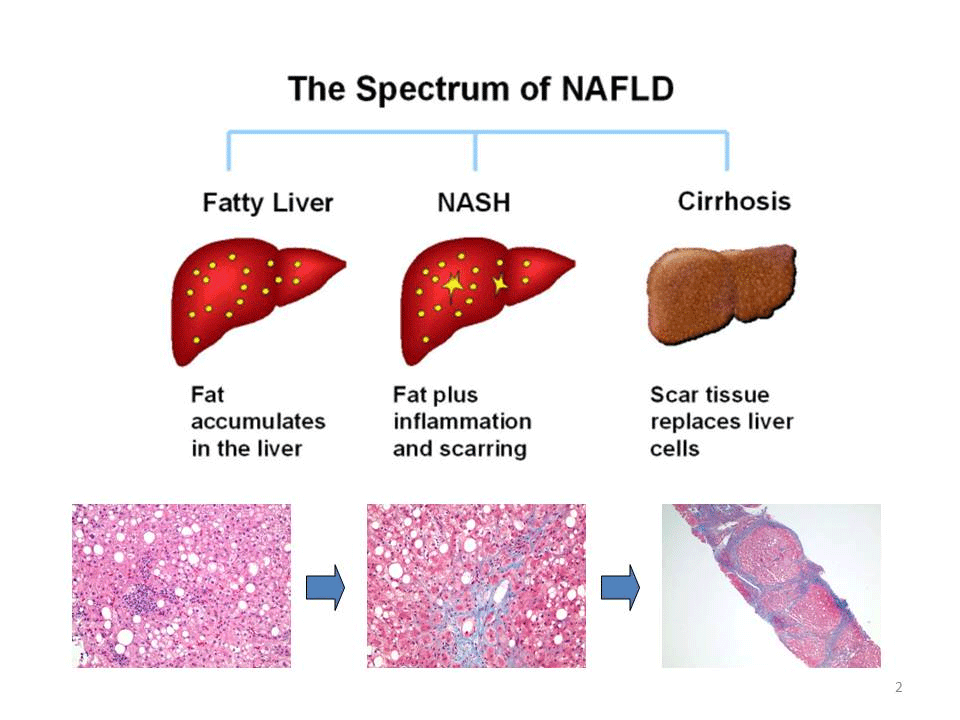 Non alcoholic fatty liver disease causes How To Get Daily
