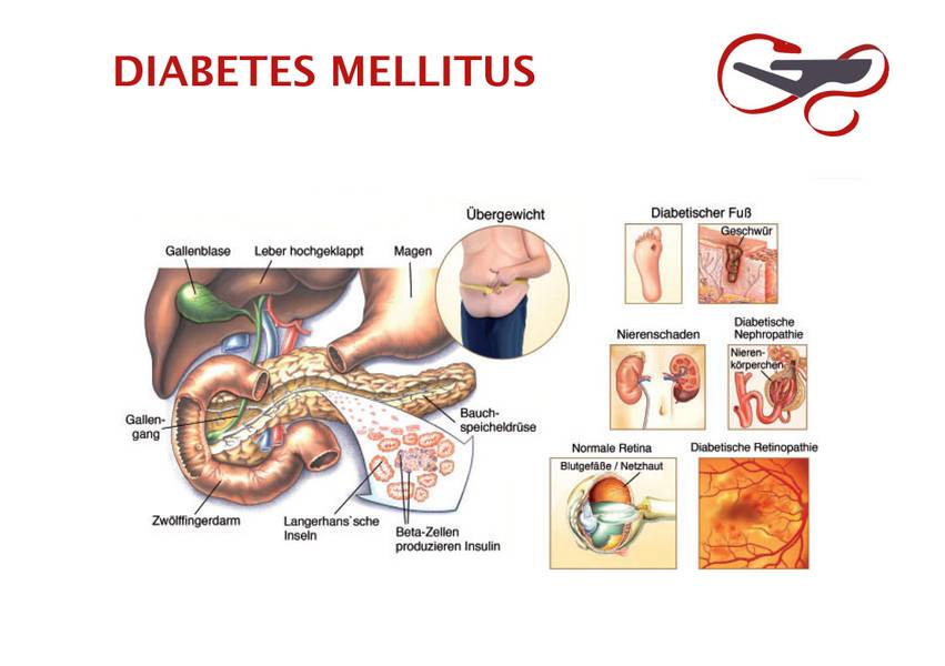 Laporan Pendahuluan dan Askep Diabetes Millitus Aplikasi