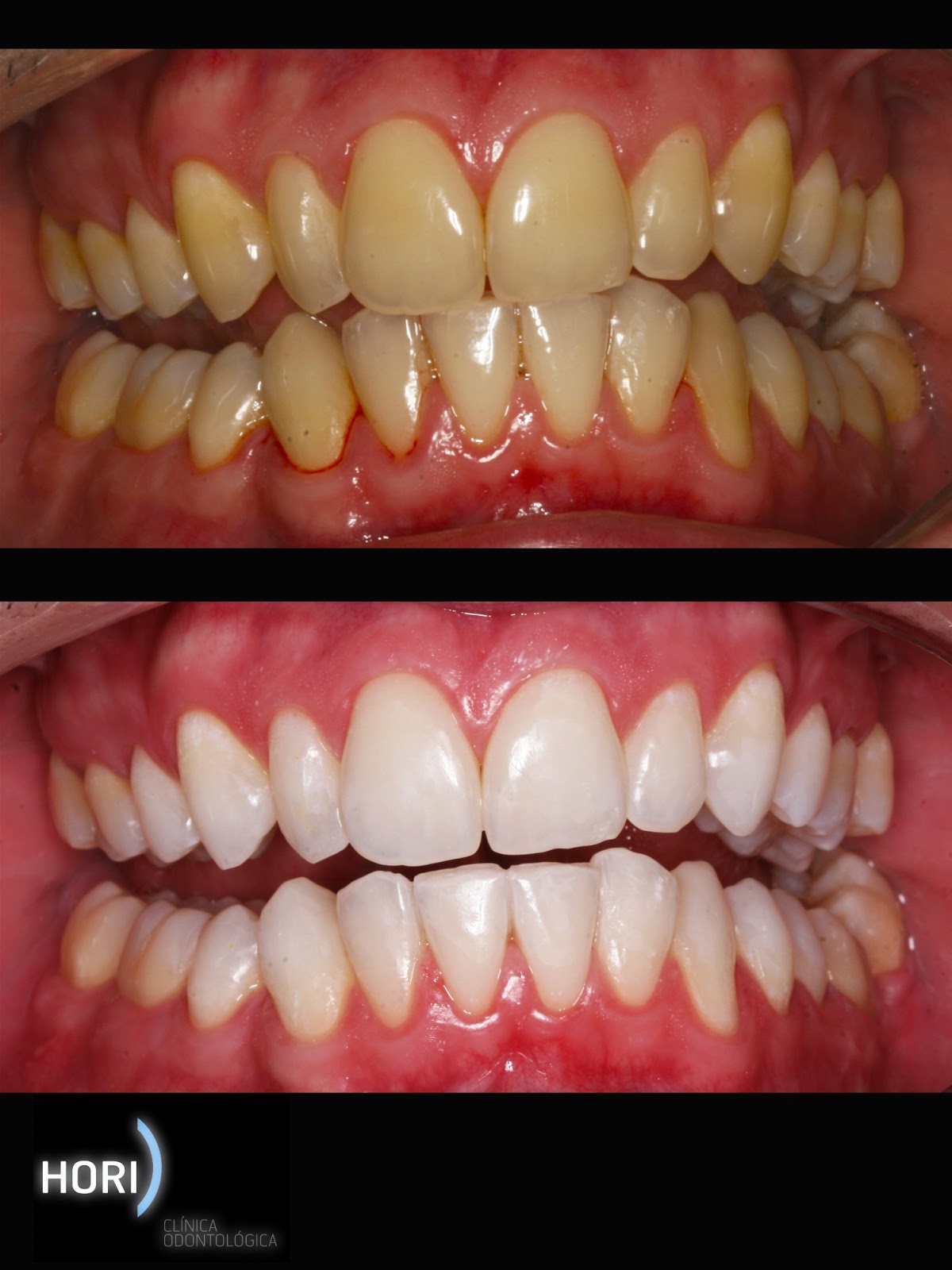 Clareamento+dental+Hori+dentista+itaim+b