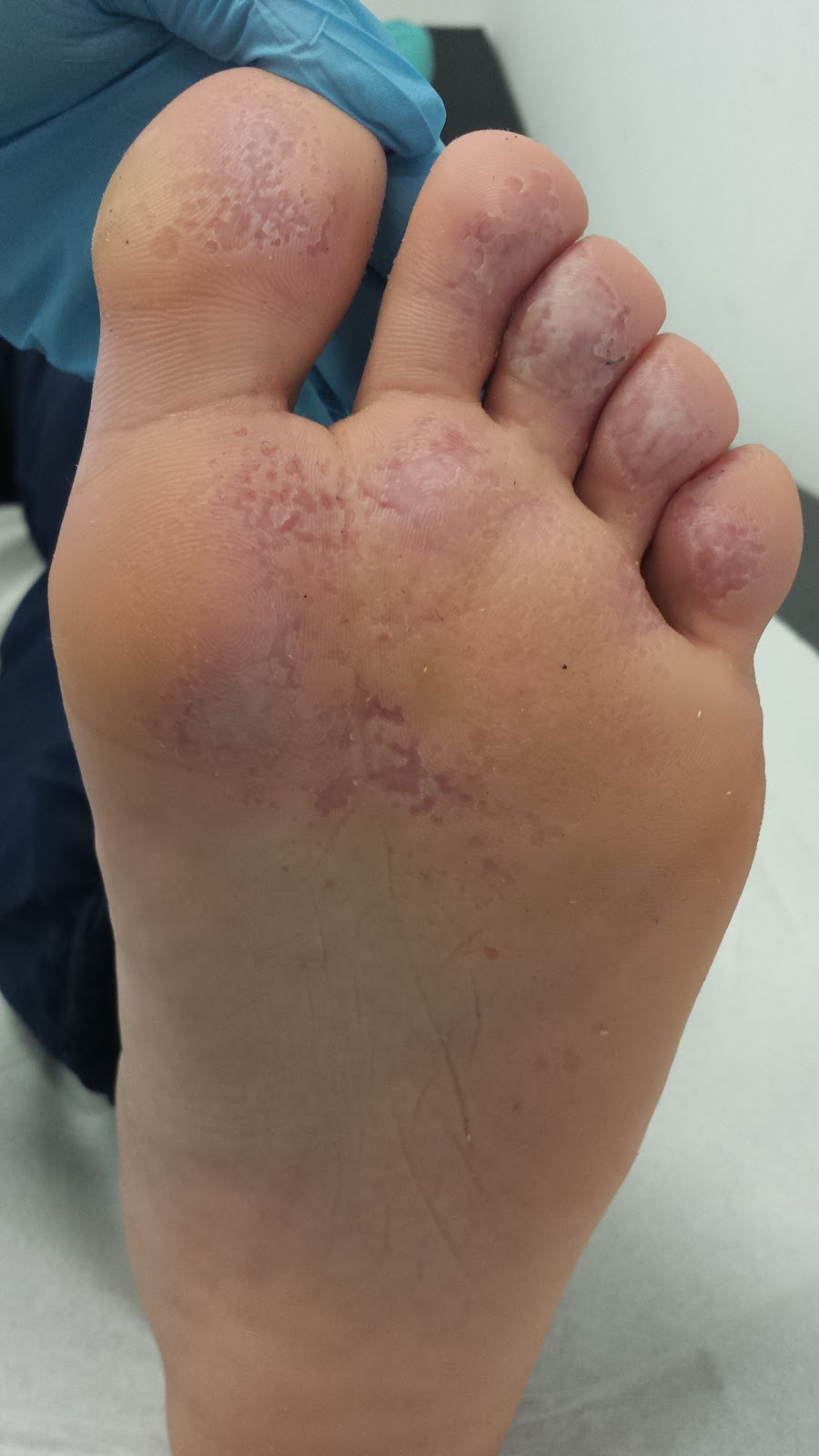 El hongo de la piel de las uñas en los pies de la foto