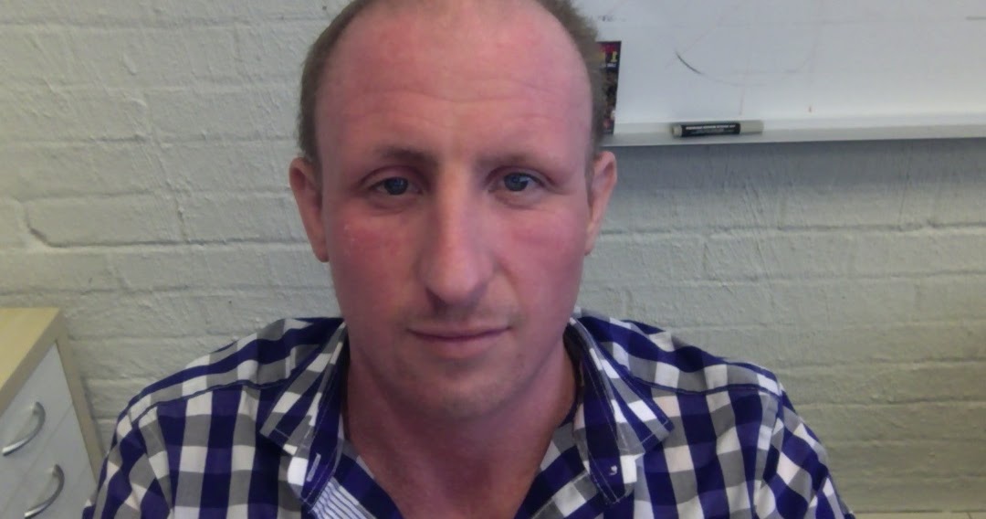 Cortisone Induced Eczema Recovery Celebrating 5 months of cortisone